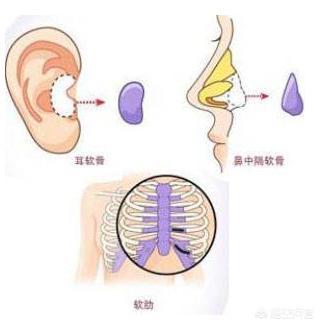 朝天鼻如何矫正，朝天鼻最佳矫正方法