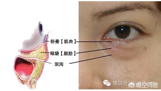 如何区分眼袋和泪沟？