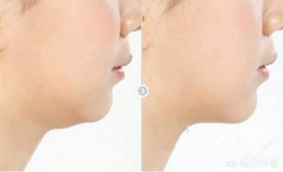 怎样做才能让脂肪脸和肌肉脸瘦下来