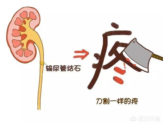 如何通过调整饮食排出肾结石?-惠修网