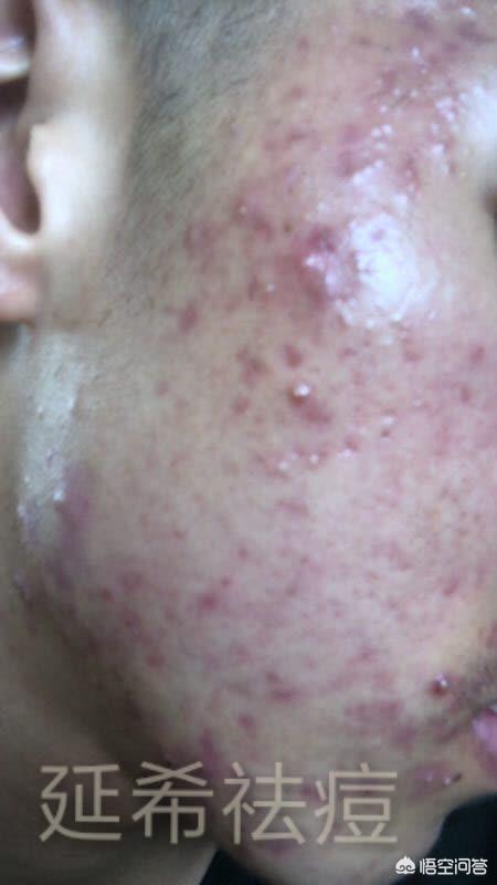 青春痘的疤痕有什么特点？