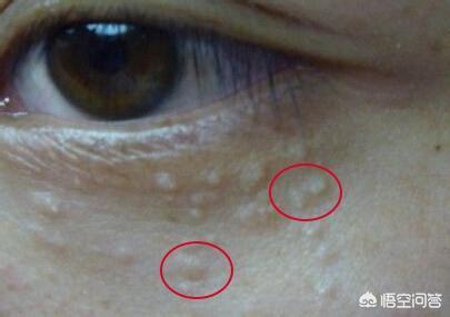 长了脂肪粒怎么办？