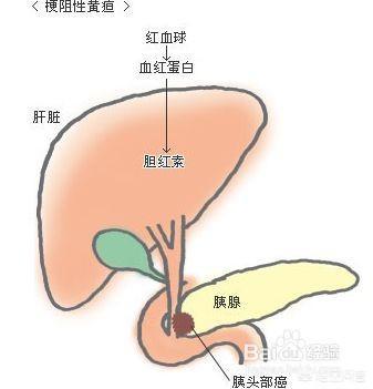 胰腺炎的症状是什么:患有胰腺炎，现已出院一个月，能吃些什么？