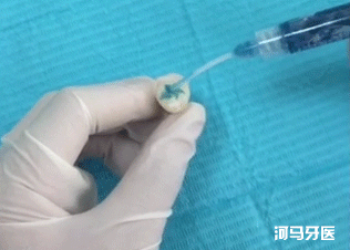 窝沟,孩子没蛀牙，要不要做窝沟封闭？