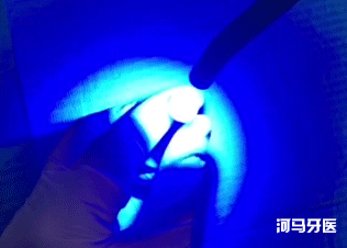 窝沟,孩子没蛀牙，要不要做窝沟封闭？