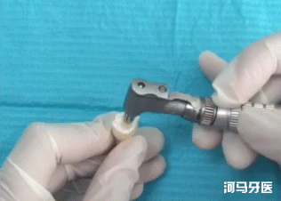 窝沟,孩子没蛀牙，要不要做窝沟封闭？