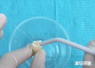 窝沟,孩子没蛀牙，要不要做窝沟封闭？