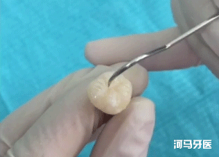窝沟,孩子没蛀牙，要不要做窝沟封闭？