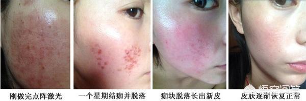 作激光能净化血液吗:脸上的红血丝可以去掉吗？