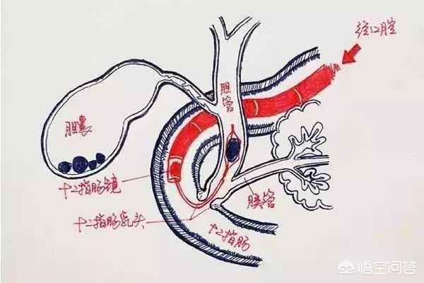 胆总管结石的症状是什么:大家对胆管结石了解多少？得了这个病治疗有什么好的建议吗？