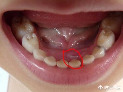 头条问答 - 6岁的小孩头牙松了去给牙医拔掉了后