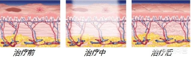 作激光能净化血液吗:脸上的红血丝可以去掉吗？