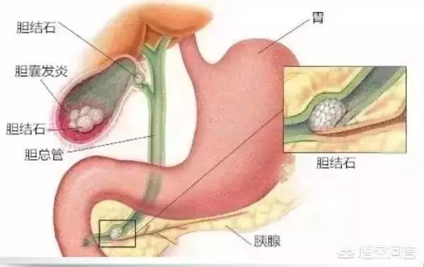 頭條問答 - 慢性膽囊炎與急性胰腺炎有關係嗎?區別是什麼?(3個回答)