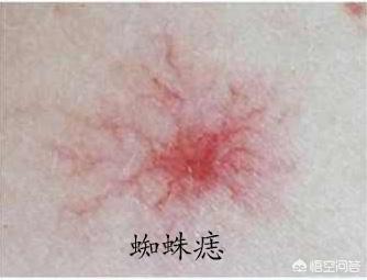 蜘蛛痣图片:身上长红色的瘊子是怎么回事？应该怎么办？