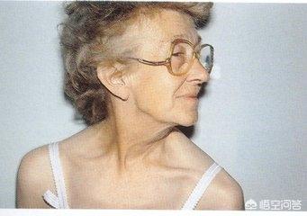 八字的结构被打乱有什么特征,痉挛性斜颈的症状有哪些？