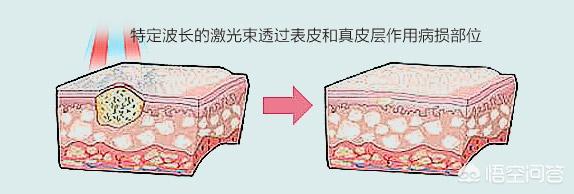 作激光能净化血液吗:脸上的红血丝可以去掉吗？