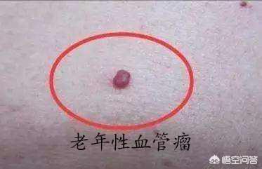 蜘蛛痣图片:身上长红色的瘊子是怎么回事？应该怎么办？