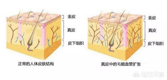 怎么去脸上的红血丝(治疗脸部红血丝最有效的方法)