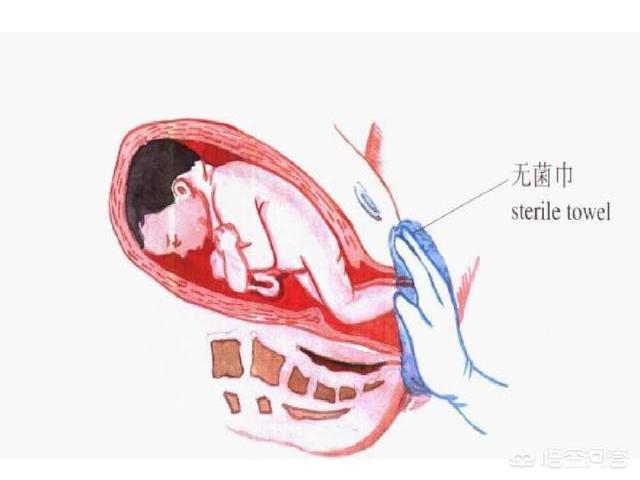 臀位生孩子前的征兆:胎儿臀位能顺产吗？胎儿臀位有办法调整吗？