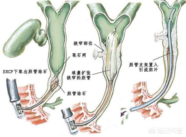 胆总管结石的症状是什么:大家对胆管结石了解多少？得了这个病治疗有什么好的建议吗？