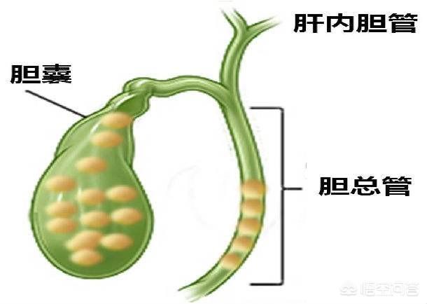 胆总管结石的症状是什么:大家对胆管结石了解多少？得了这个病治疗有什么好的建议吗？