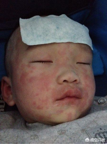 宝宝突然长荨麻疹了，然后就一直反反复复的，该怎么办？