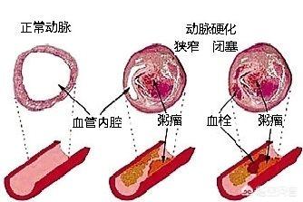 墨西哥血脚背甲:拳头握紧随后松开，摸脚背血管，真的能知道是否患上动脉硬化吗？