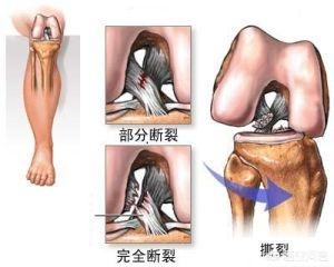 半月板撕裂:右膝关节韧带断裂，半月板撕裂，以后还能做体力活吗？