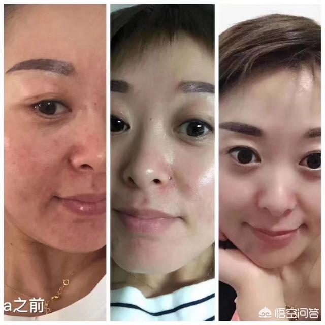 去痤疮面膜(去痤疮面膜牌子)