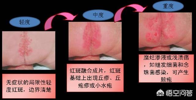宝宝红屁股尿不湿多久换一次:经常换纸尿裤，为什么宝宝还是红屁股？