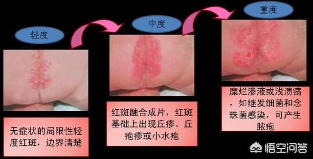 宝宝红屁股尿不湿多久换一次:经常换纸尿裤，为什么宝宝还是红屁股？