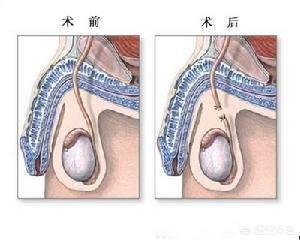 男性结扎的好处和坏处:生了二胎后不想要孩子了，做结扎对身体好不好？