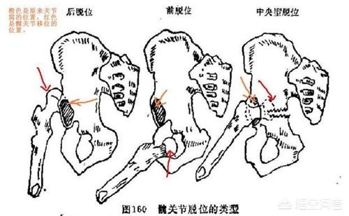 髋关节脱位:髋关节脱位分为哪几种类型？应该如何诊治？