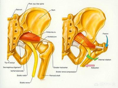 简稚澄百度百科:梨状肌和腰稚间盘突出有区别吗？