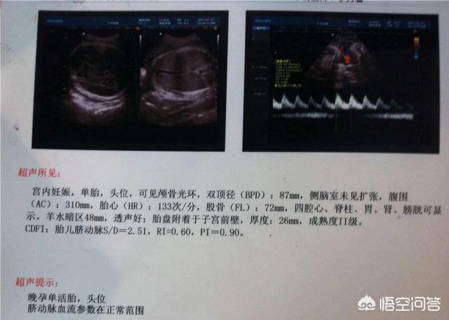 初怀孕多久能做b超:初孕多久可以做b超 第一次做B超应该是怀孕多久之后？