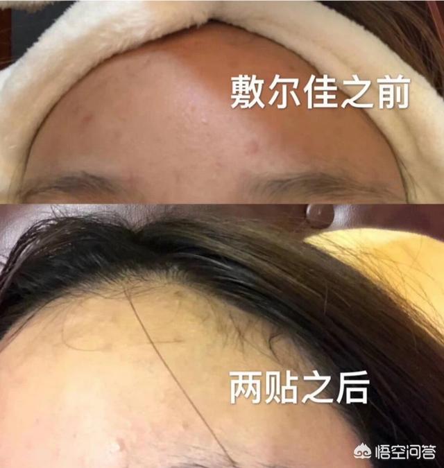 去痤疮面膜(去痤疮面膜牌子)