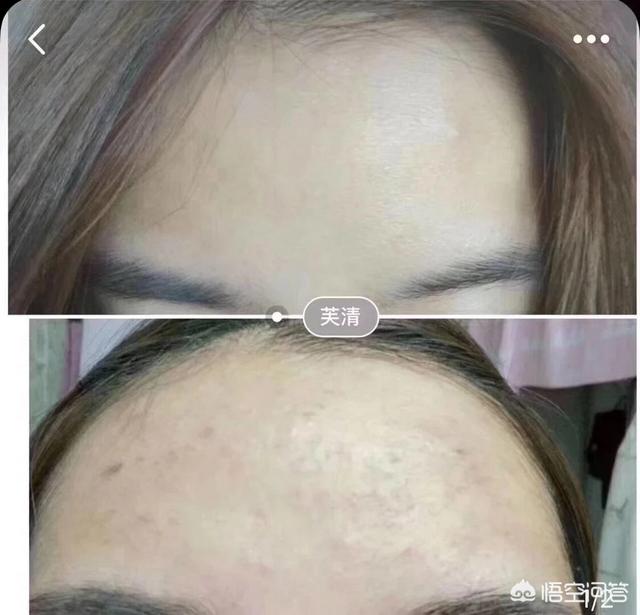 去痤疮面膜(去痤疮面膜牌子)