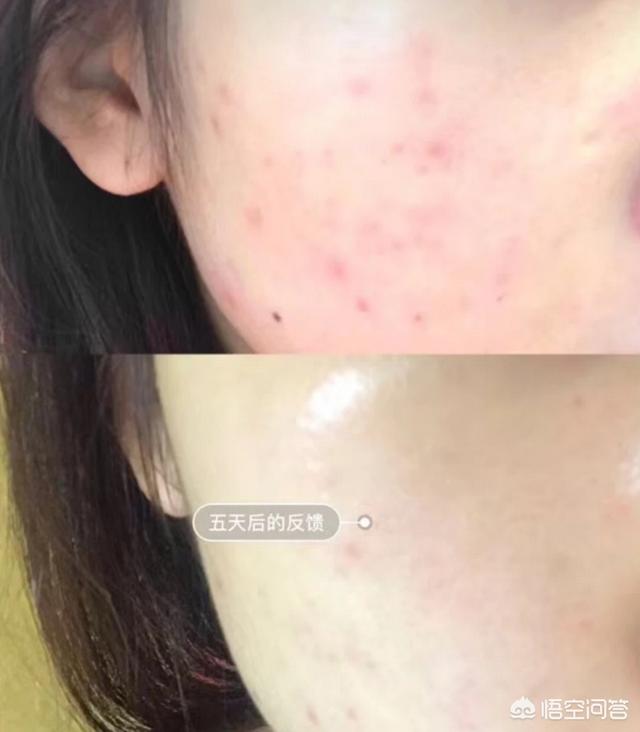 去痤疮面膜(去痤疮面膜牌子)