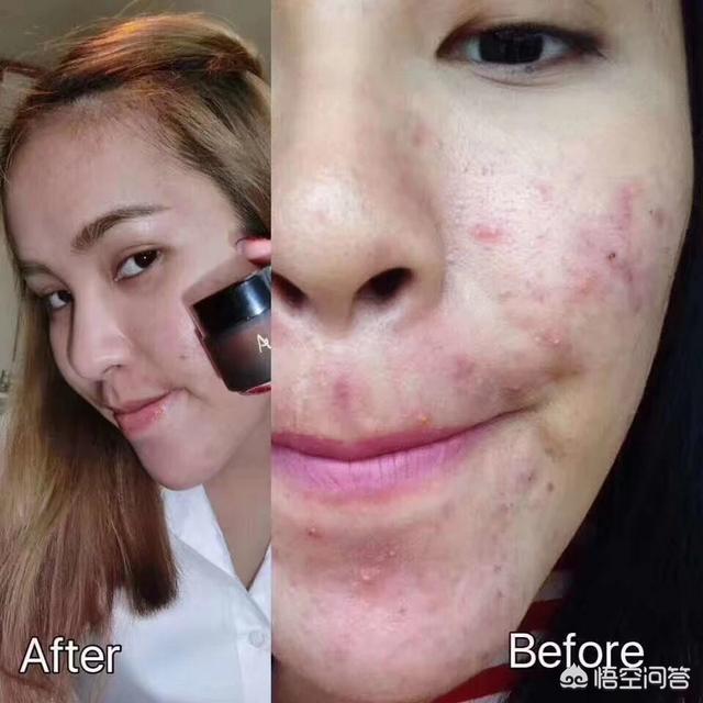 去痤疮面膜(去痤疮面膜牌子)