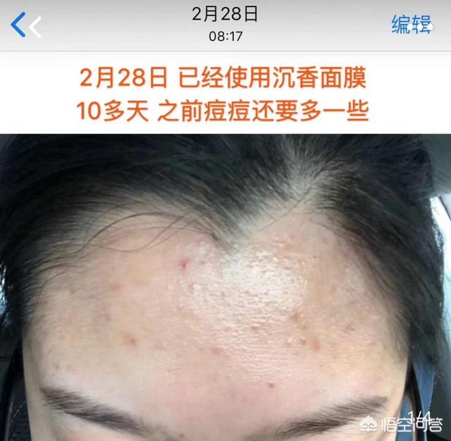 去痤疮面膜(去痤疮面膜牌子)