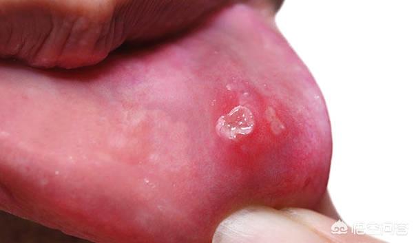 儿童口腔溃疡症状:儿童口腔溃疡是什么引起的 经常性口腔溃疡是种什么体验？