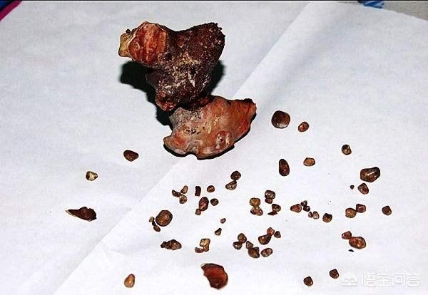 肾结石吃药可以变小吗？