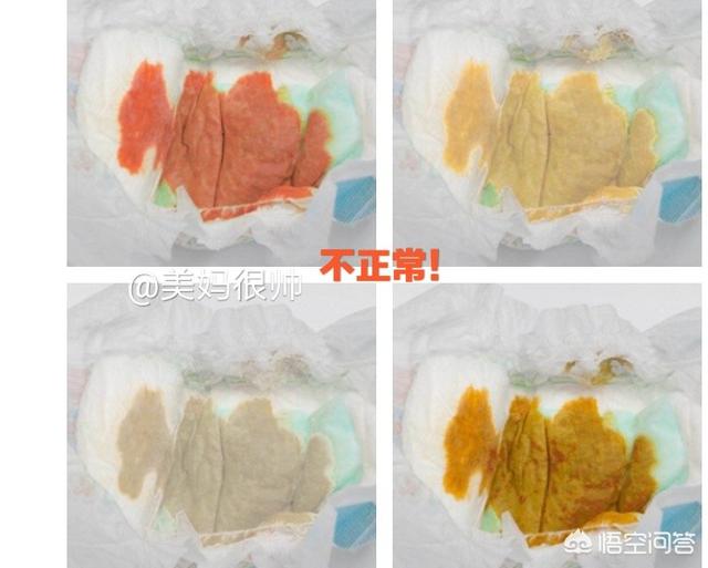 婴儿胆道阻塞的症状:如何从宝宝的便便来判断宝宝的消化情况？