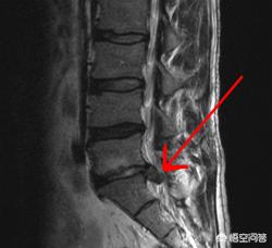 车身控制 跛行回家:因腰椎间盘突出导致间歇性跛行的人，应该怎么治疗？