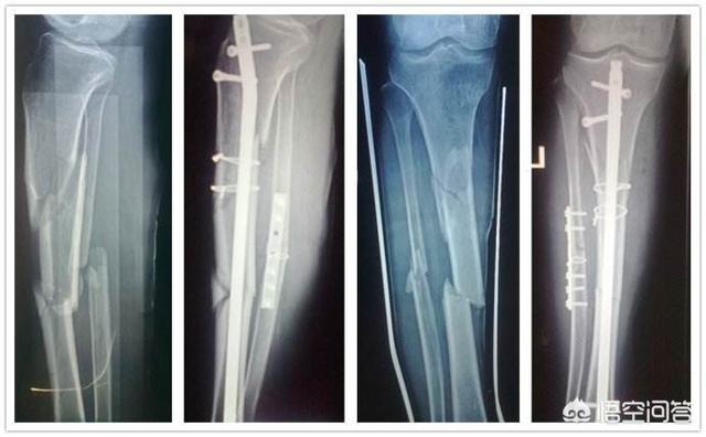 胫腓骨骨折:胫腓骨骨折康复训练图 胫腓骨骨折三月不长正常吗？