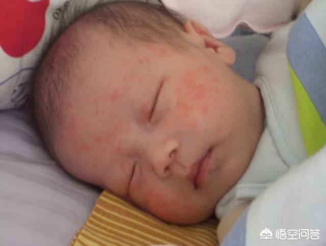 宝宝皮肤干燥、脱皮、起红点还痒，好像是湿疹，该怎么治疗？