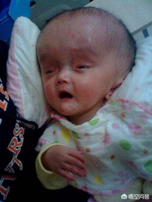 小儿轻度脑积水的症状:如何发现婴儿摔伤头部后引起的慢性脑积水？