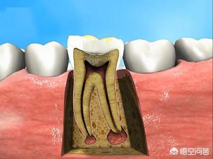你知道:牙松动的最主要的原因是什么?-头条问答