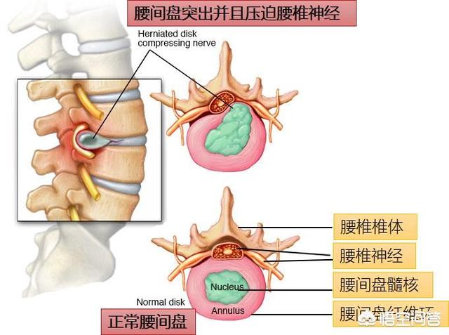 腿神经痛怎么治疗:大腿和小腿神经痛是怎么回事，该如何治疗？(小腿神经疼是怎么回事)