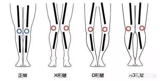 怎么矫正XO型腿，如何练习瑜伽矫正X型腿？